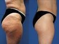 cellulite-cuisses-fesses-cavitation-radiofréquence